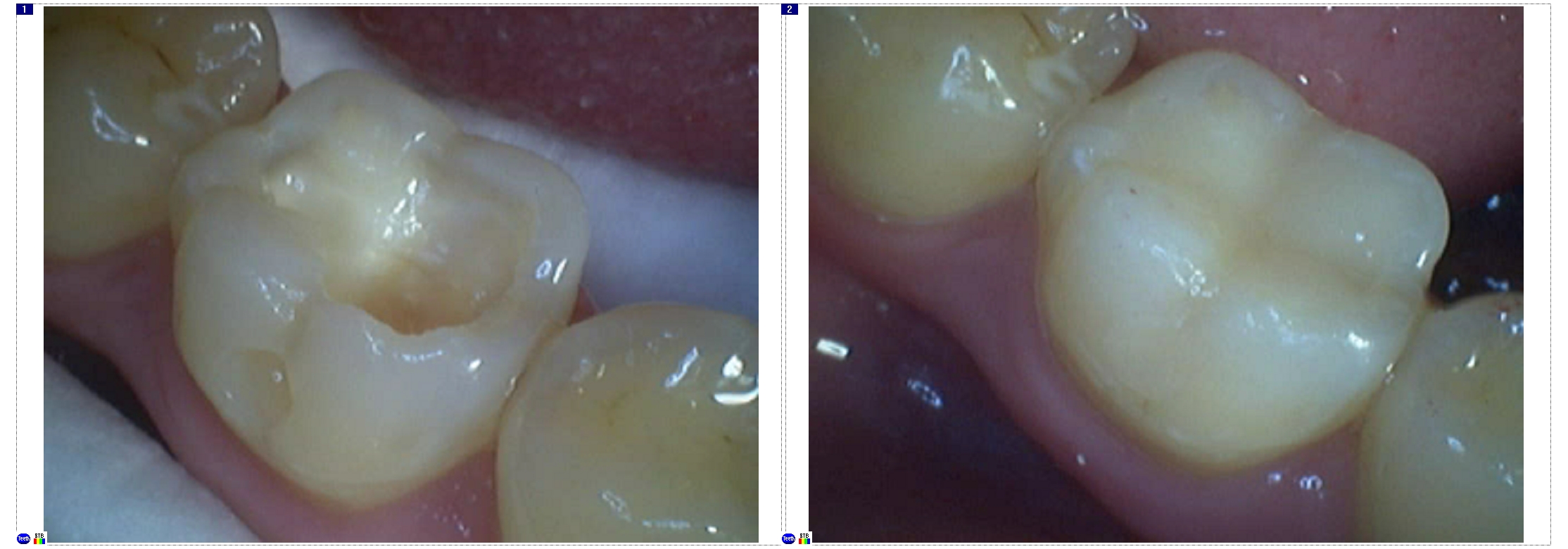 Реставрационная стоматология и виды восстановления зубов - Вестник Кипра